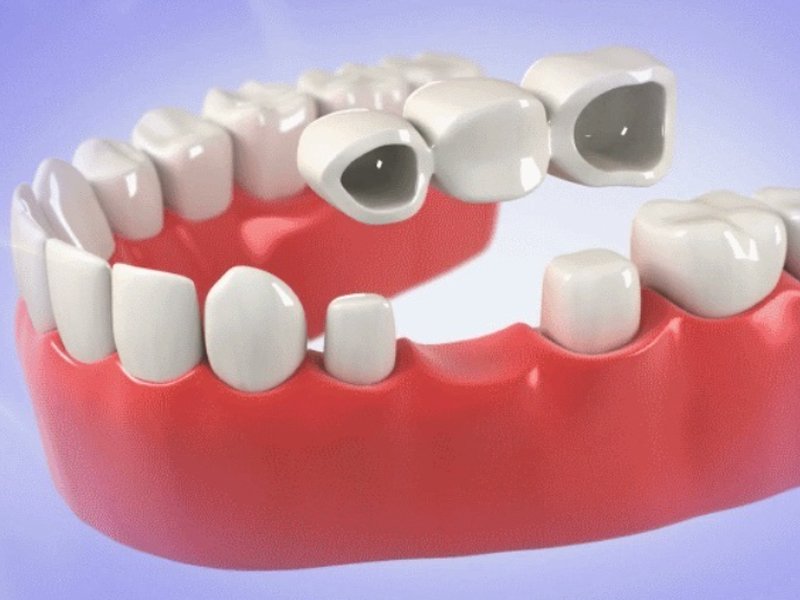 5 điều cần biết về bọc răng sứ 5 điều cần biết về bọc răng sứ