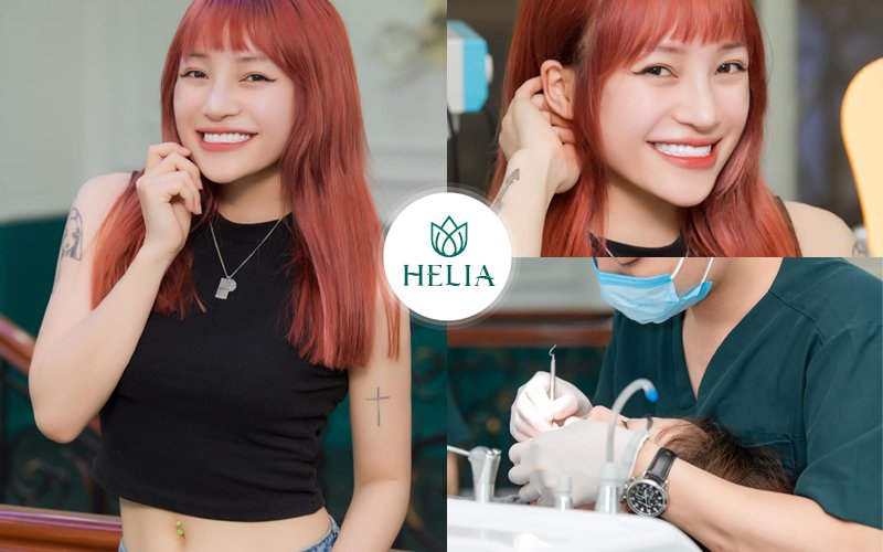 Ưu - Nhược điểm khi làm cầu răng sứ Bọc răng sứ Pico Zolid: Không đau - Không mài nhỏ - Không điều trị tuỷ.